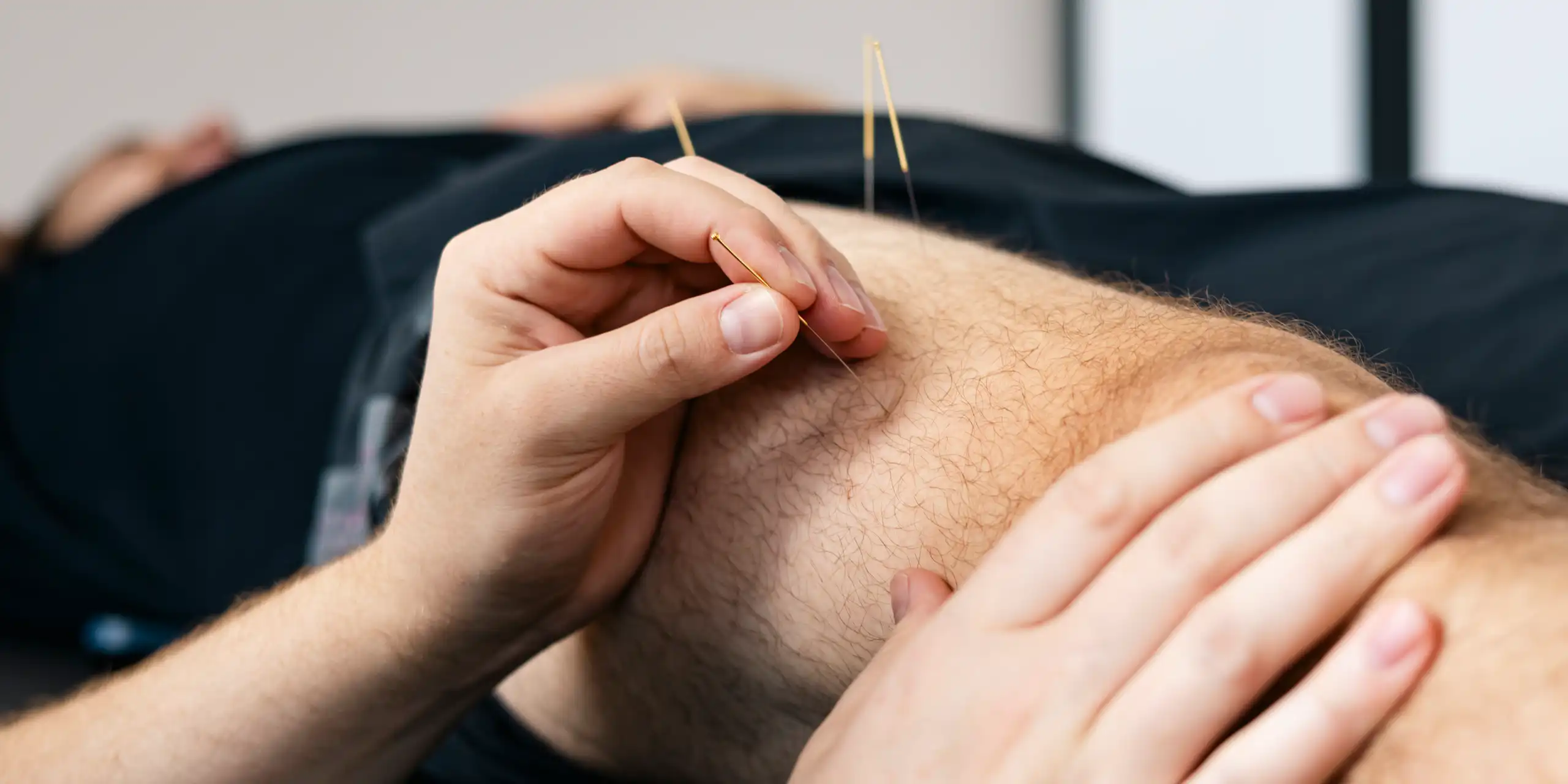 Physiotherapist doing dry needling therapy on a man's leg