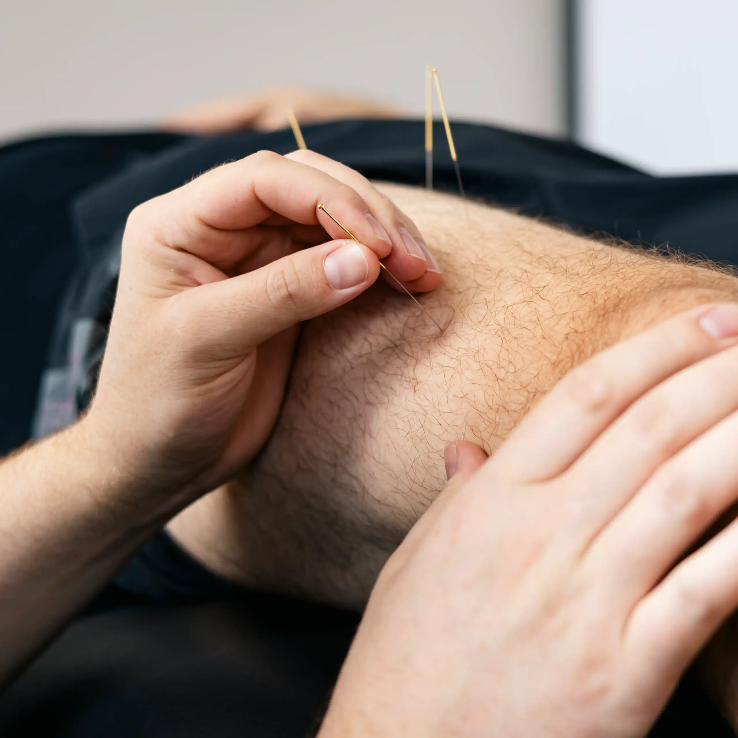 Physiotherapist doing dry needling therapy on a man's leg