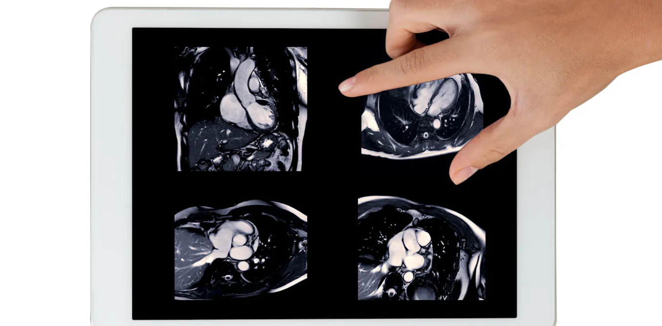 New MRI Technique Promises Simpler, More Precise Heart Attack Analysis in France