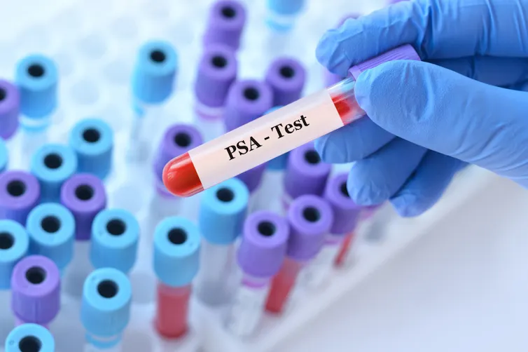 A phial of blood with 'PSA test' written on the label.