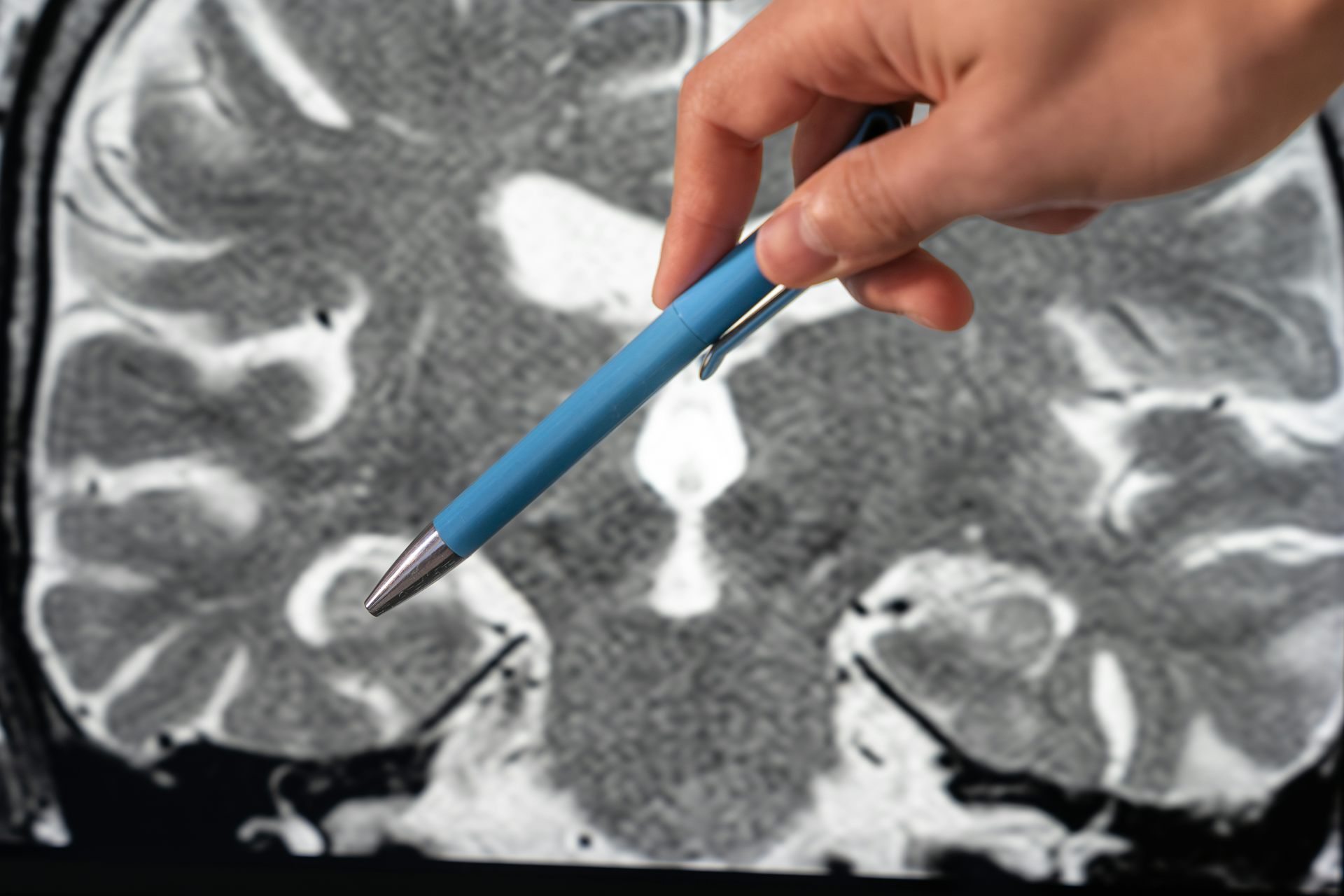 Close up of hand holding a blue pen points to the right hippocampus in a detailed coronal T2-weighted brain MRI.