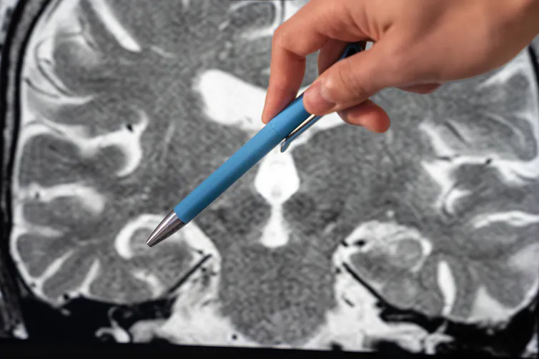 Close up of hand holding a blue pen points to the right hippocampus in a detailed coronal T2-weighted brain MRI.