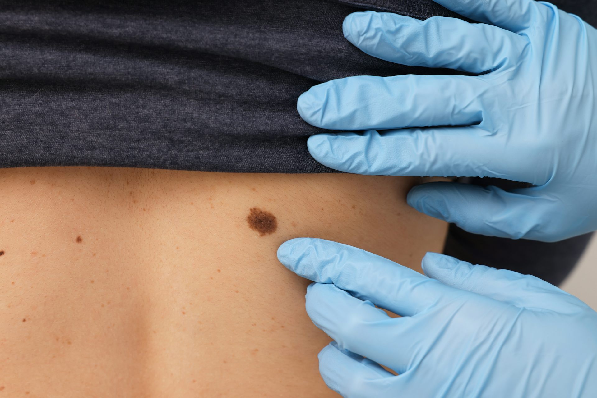 Así funciona a nivel molecular la nueva terapia contra el melanoma