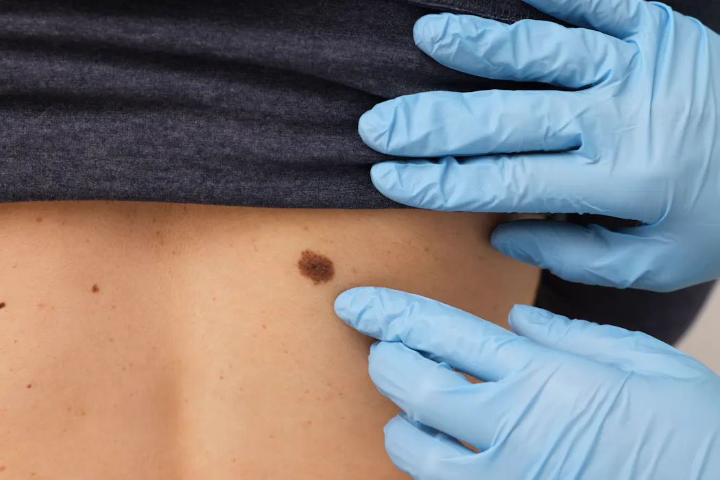 Así funciona a nivel molecular la nueva terapia contra el melanoma