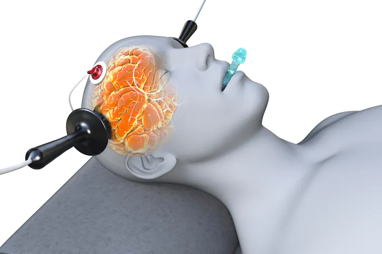 A digital rendering of a person receiving electroconvulsive therapy, with an electrical current passing through their brain.