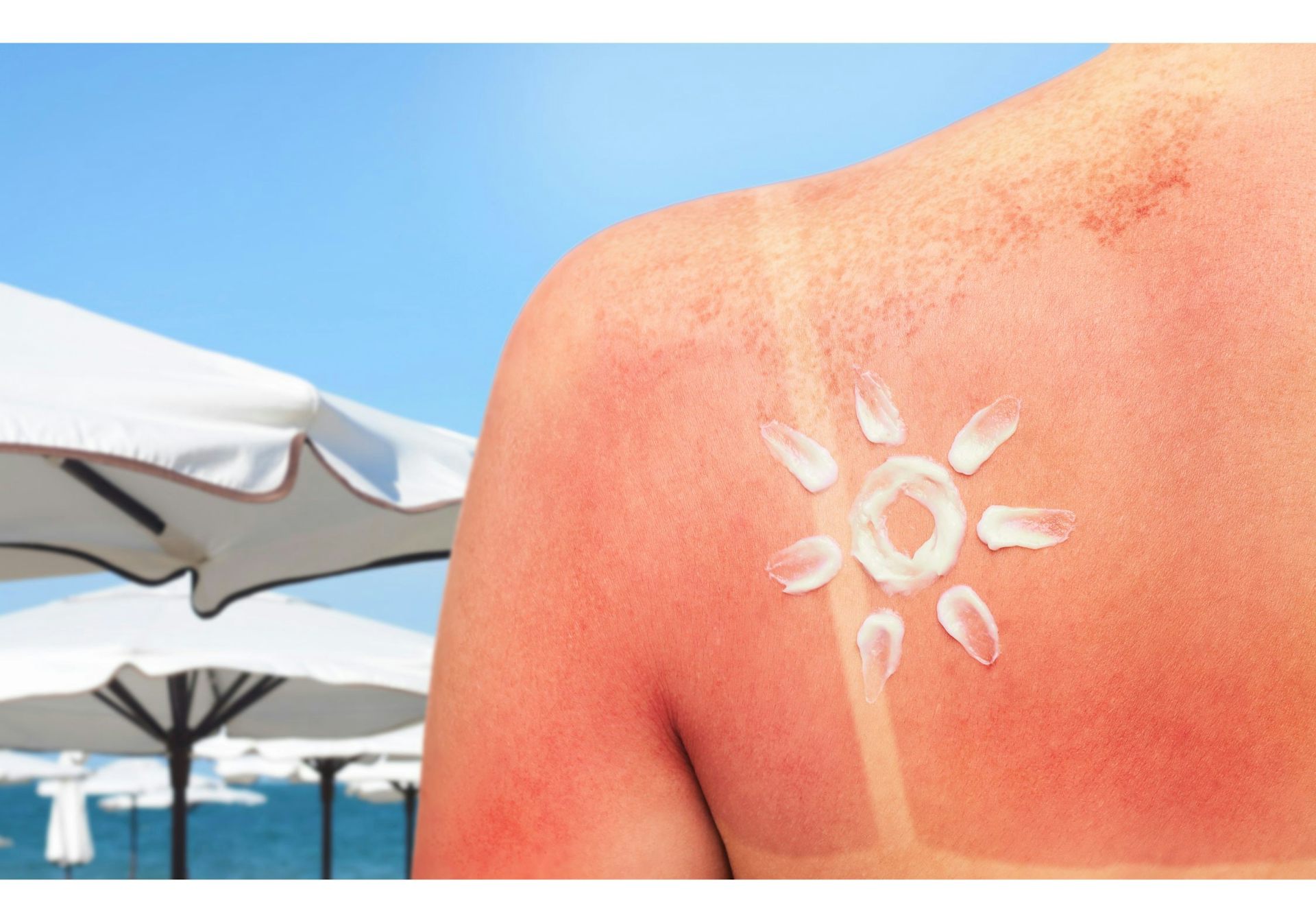 The back of a sunburned shoulder, with a sun drawn in white sunscreen