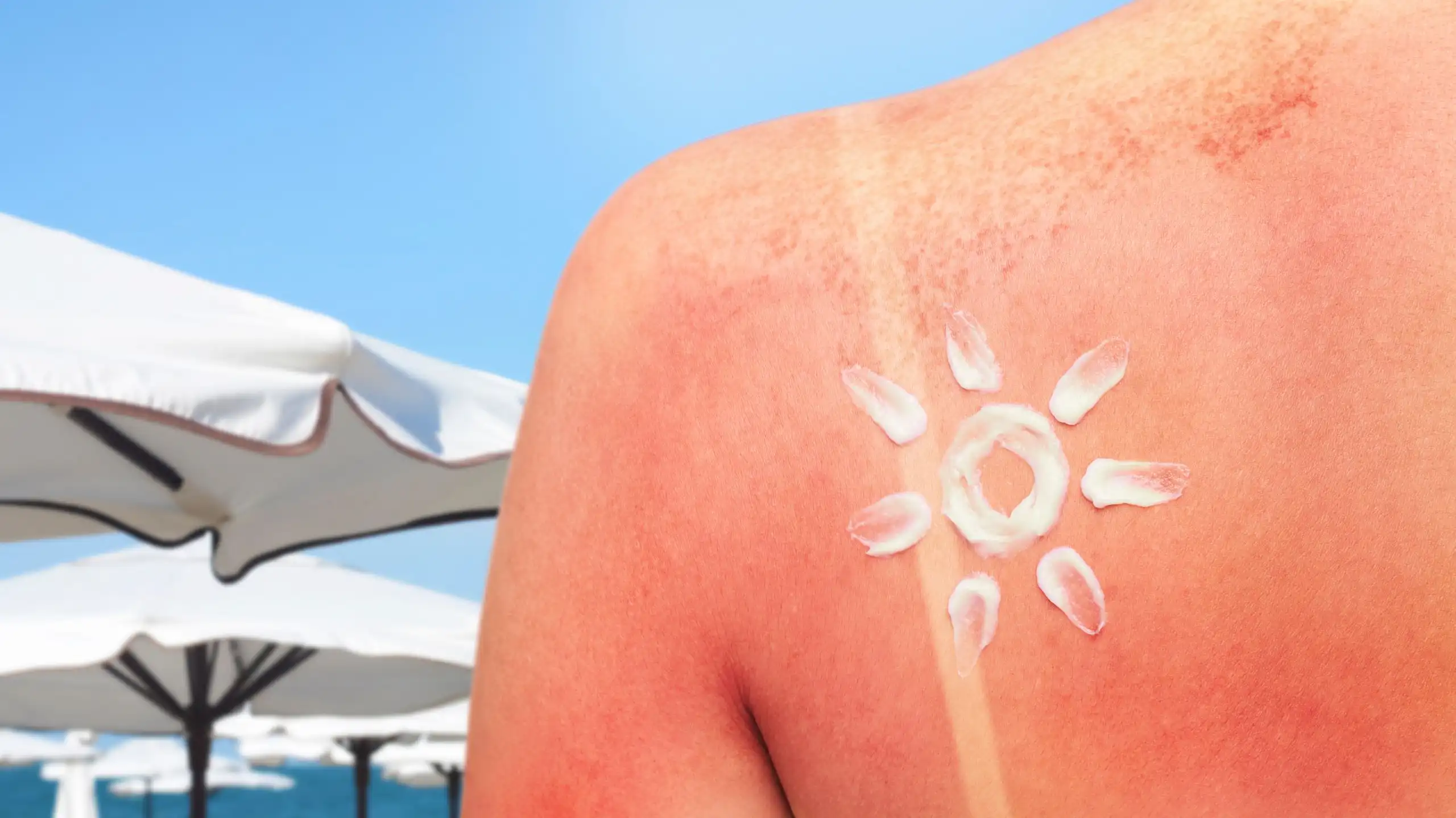 The back of a sunburned shoulder, with a sun drawn in white sunscreen