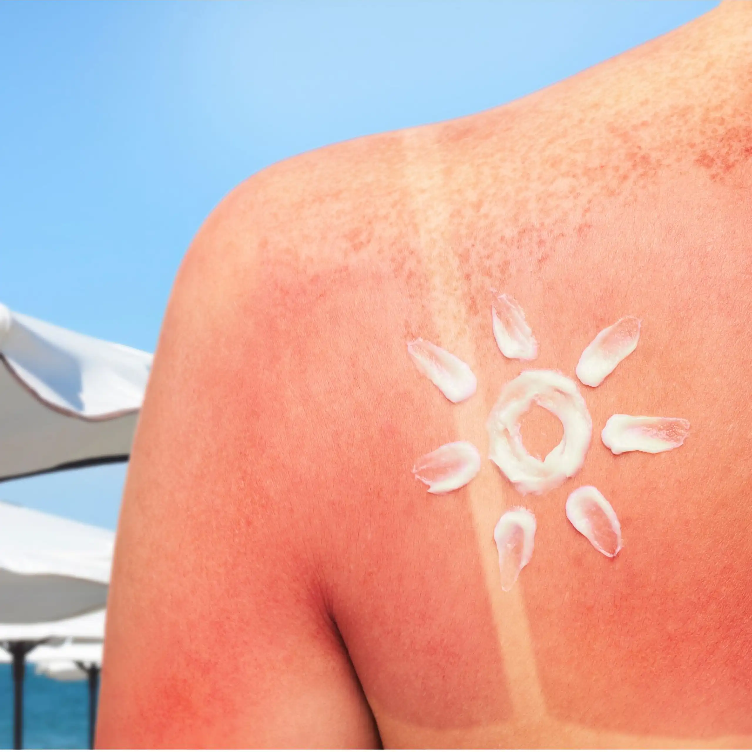 The back of a sunburned shoulder, with a sun drawn in white sunscreen