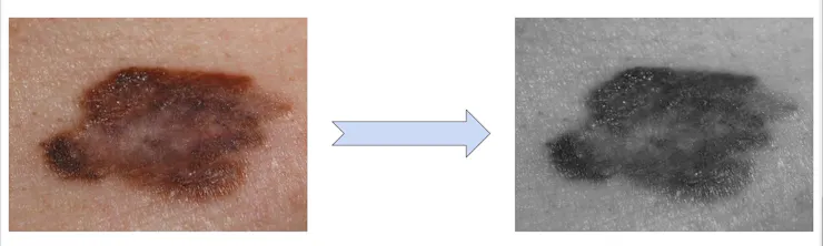 On the left, an image of a brown-purple mole on light skin. On the right, the same picture, darkened.
