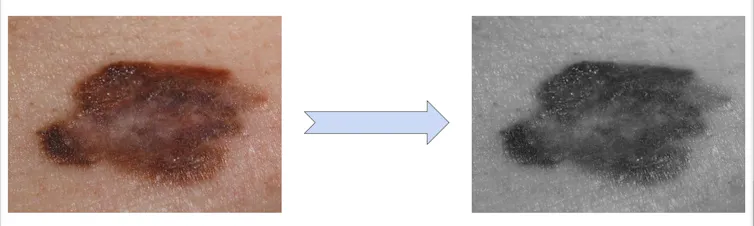 On the left, an image of a brown-purple mole on light skin. On the right, the same picture, darkened.