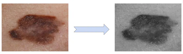 On the left, an image of a brown-purple mole on light skin. On the right, the same picture, darkened.