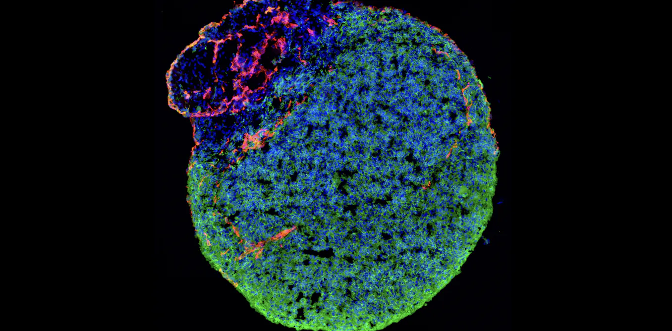 Des organoïdes cérébraux complexes pour mieux comprendre les cancers du cerveau