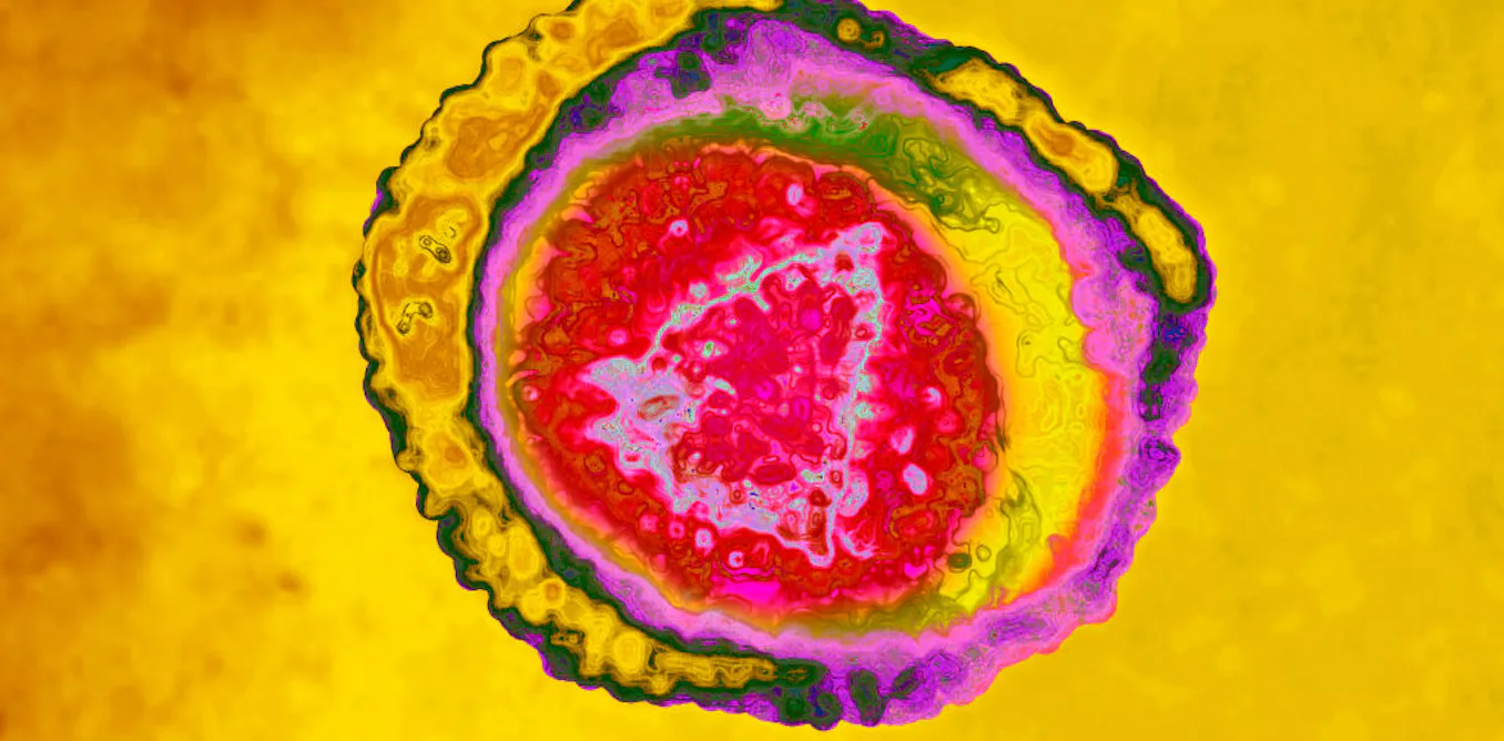 Shingles can cause severe chronic pain – new research on how exosomes alter neurons offers pathways to treatment