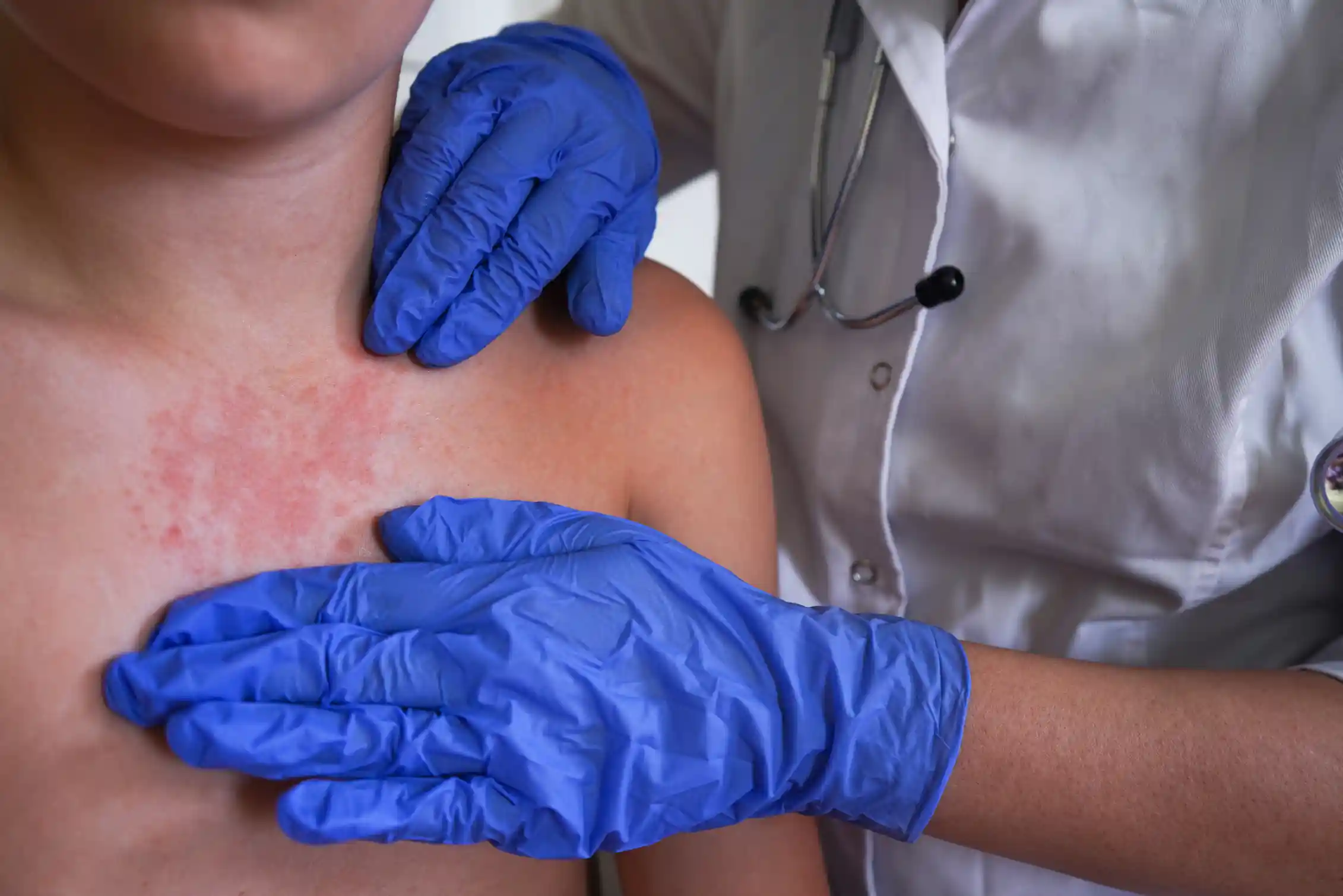Gloved hands of a medical professional examine a rash on a child