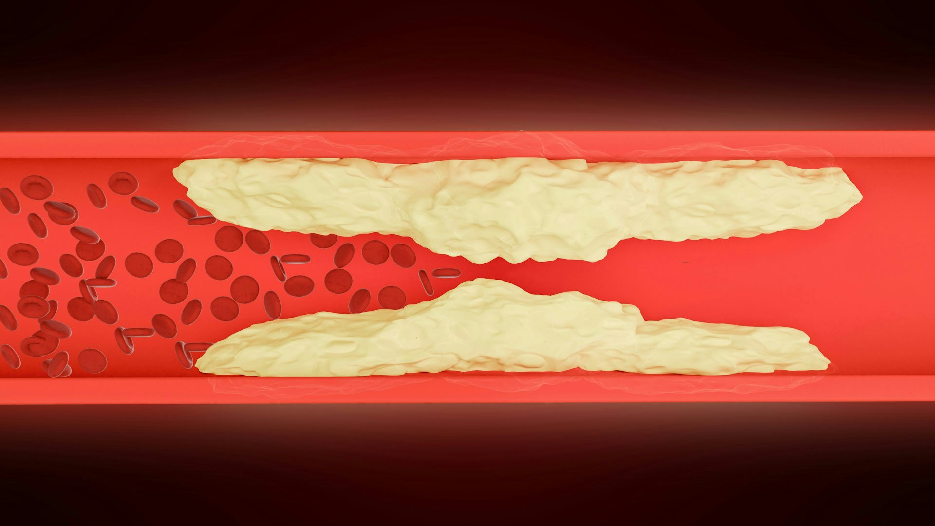 Illustration of a red blood vessel with yellowish plaque narrowing the flow of blood.
