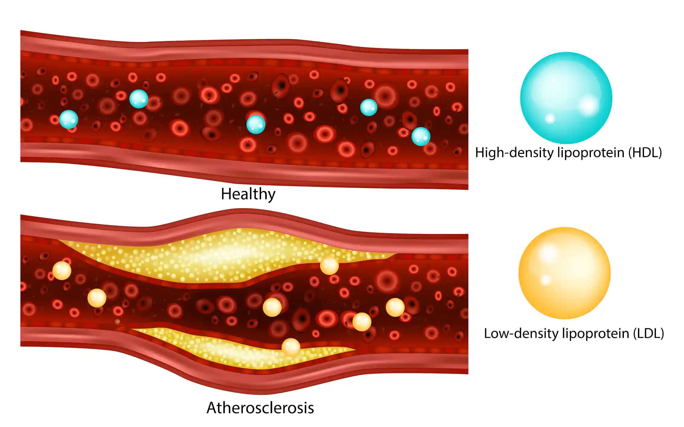 Illustration of a healthy blood vessel on top of a bulging blood vessel with atherosclerosis.