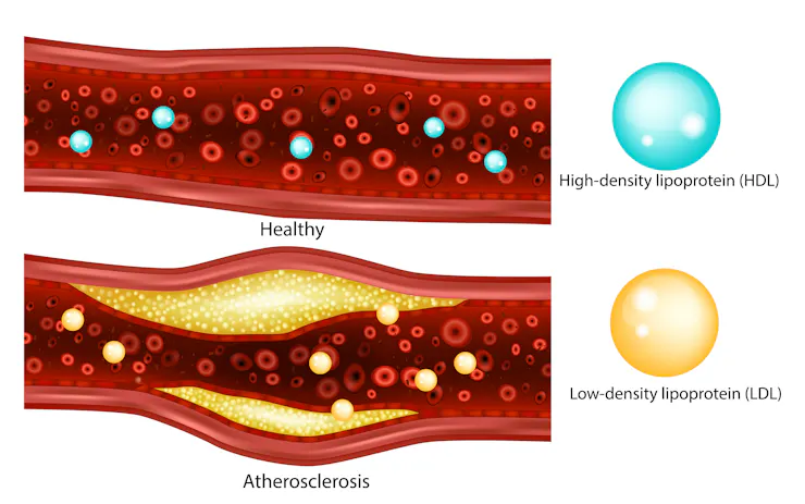 Illustration of a healthy blood vessel on top of a bulging blood vessel with atherosclerosis.