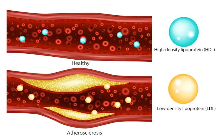 Illustration of a healthy blood vessel on top of a bulging blood vessel with atherosclerosis.