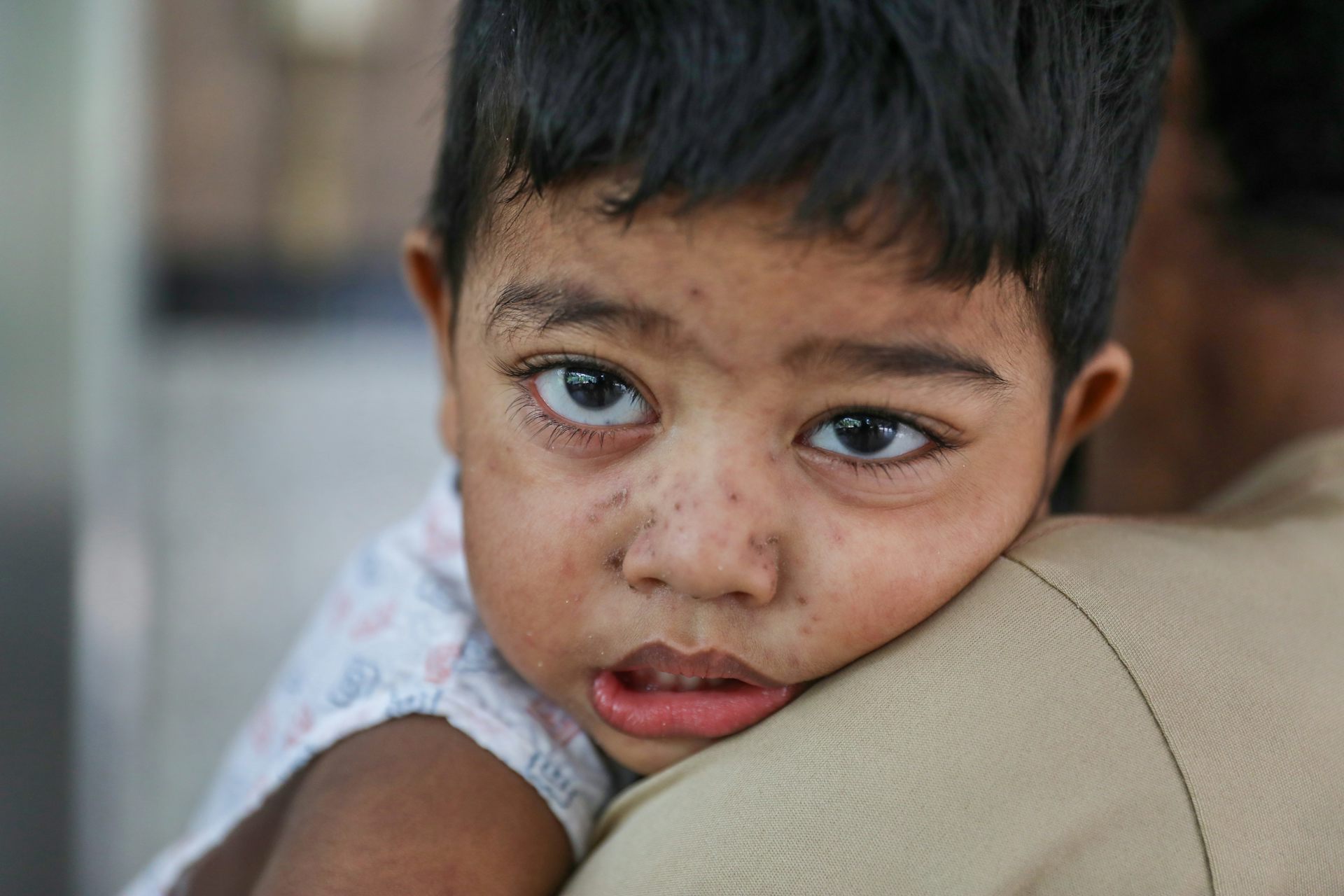 A child receives treatment after showing measles-like symptoms at DNCC Dedicated Hospital in Dhaka, Bangladesh, 18 September 2026.