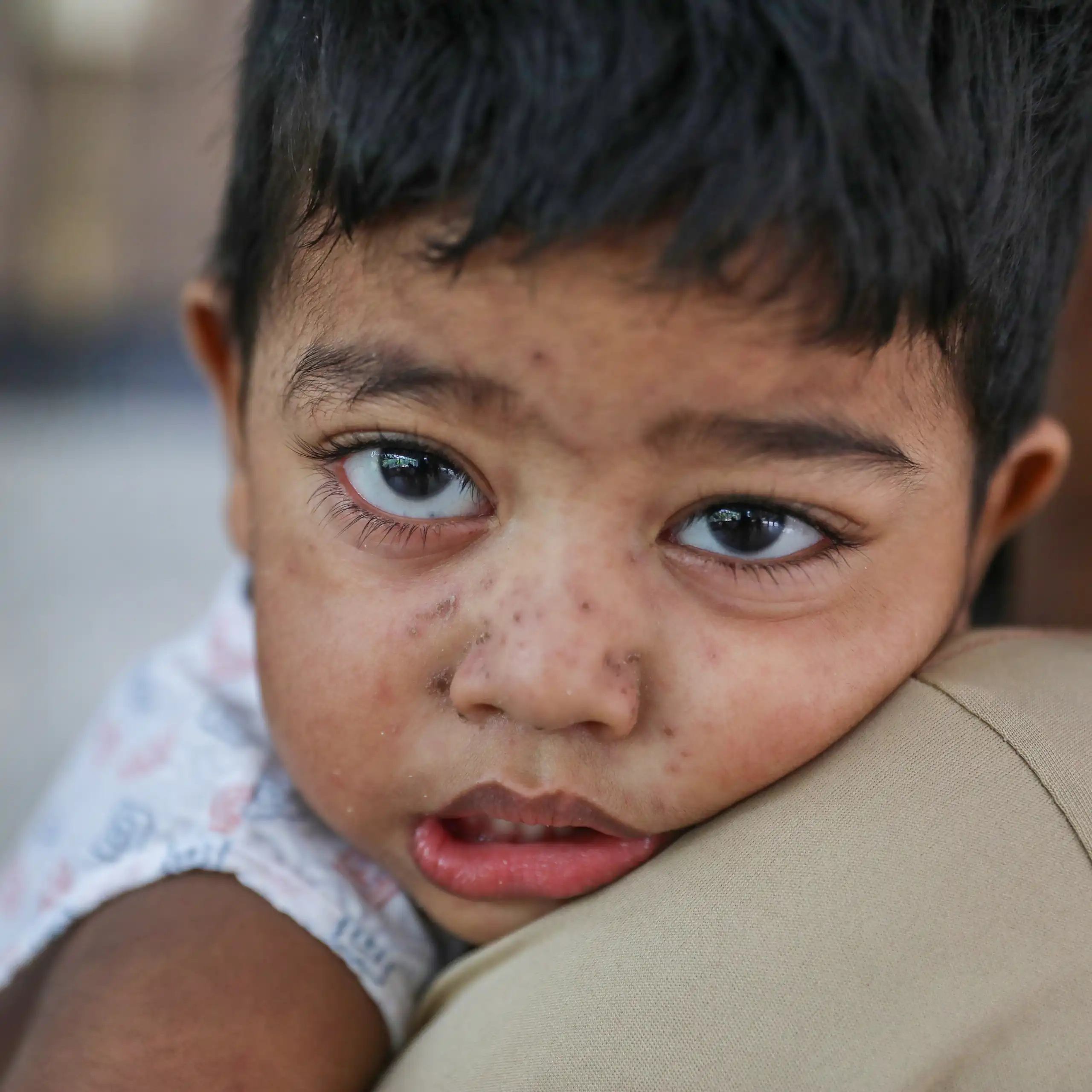 A child receives treatment after showing measles-like symptoms at DNCC Dedicated Hospital in Dhaka, Bangladesh, 18 September 2026.