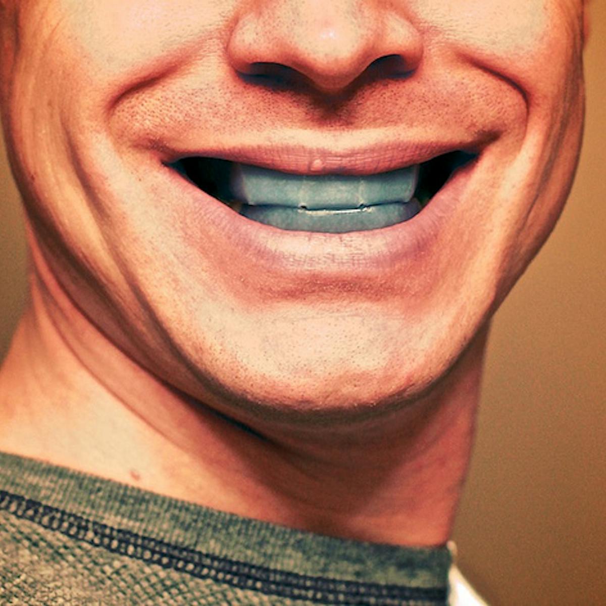 What Happens When Teeth Whitening Goes Wrong What Happens When Teeth Whitening Goes Wrong