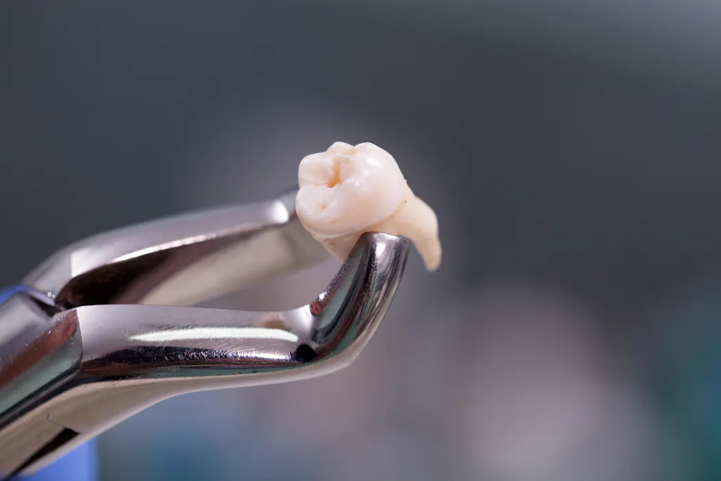 First case of teeth growing out of an eye socket – what you need to know about ‘ectopic teeth’