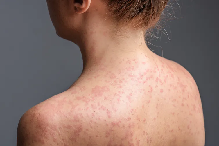 A person's back covered in measles rash.