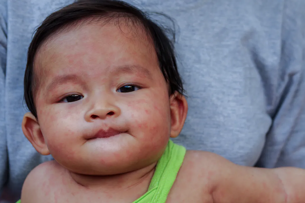 Vaccines have been so successful that some people have forgotten why we need them