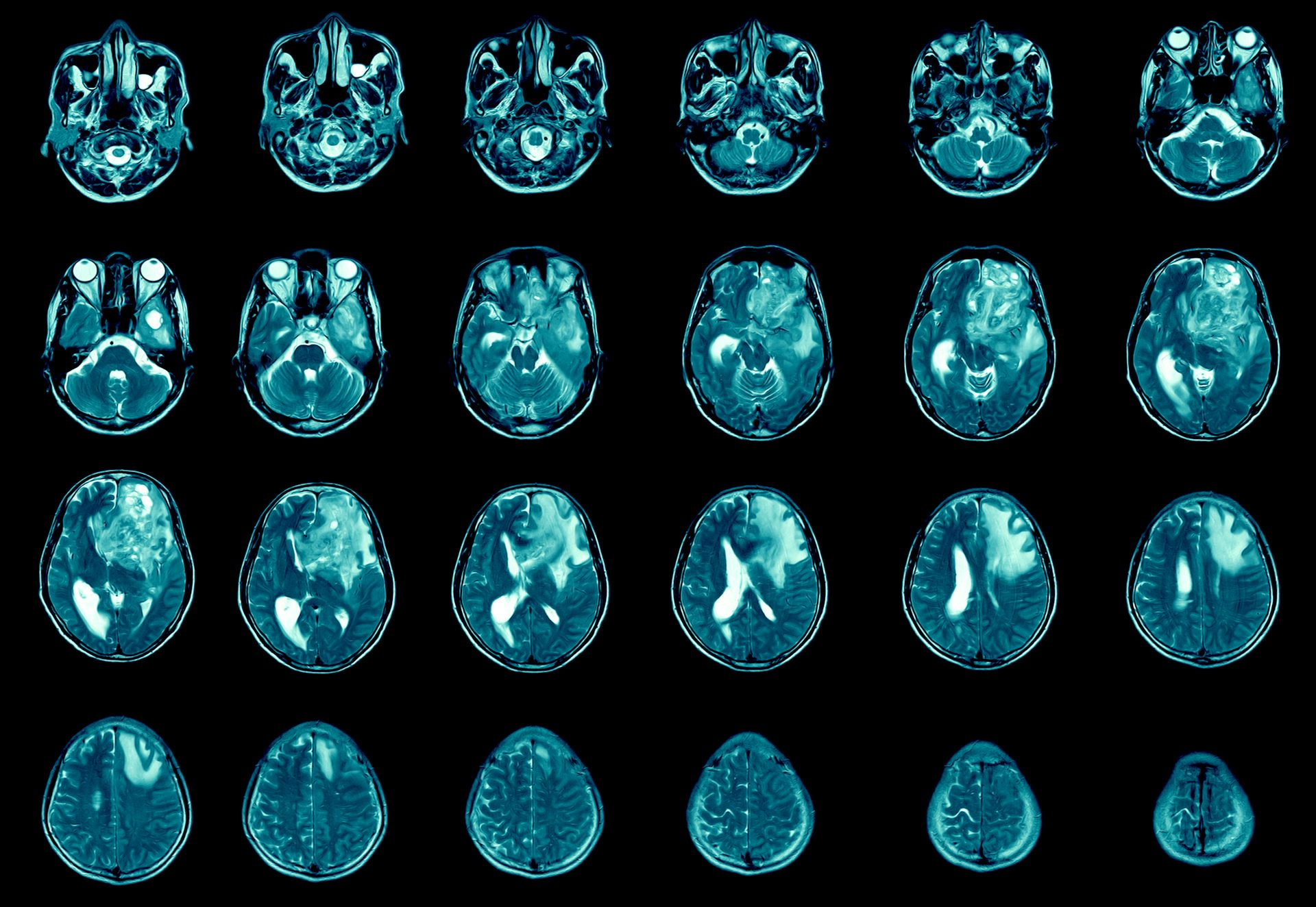 Imagens de ressonância magnética de um cérebro com glioblastoma