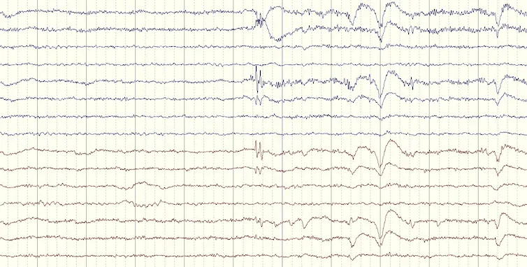 An EEG of human brain activity, recorded as a series of jagged lines on a screen