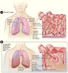 Diagram comparing alveoli of person with scarred or non-scarred lung tissue