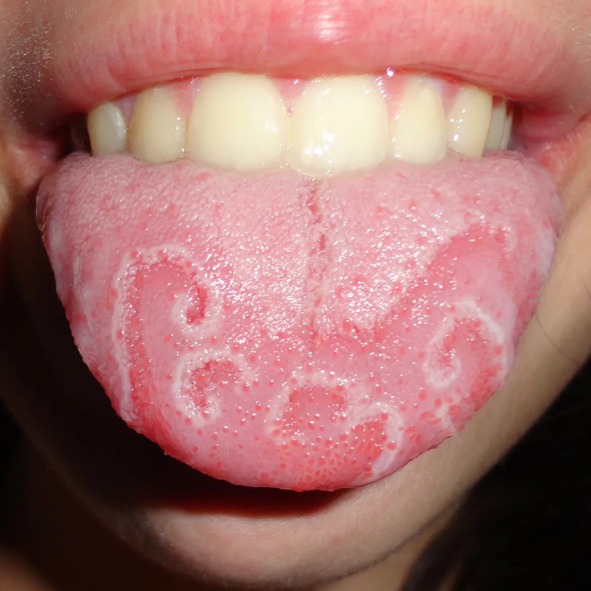 Geographic tongue: the mysterious condition that makes maps in your mouth