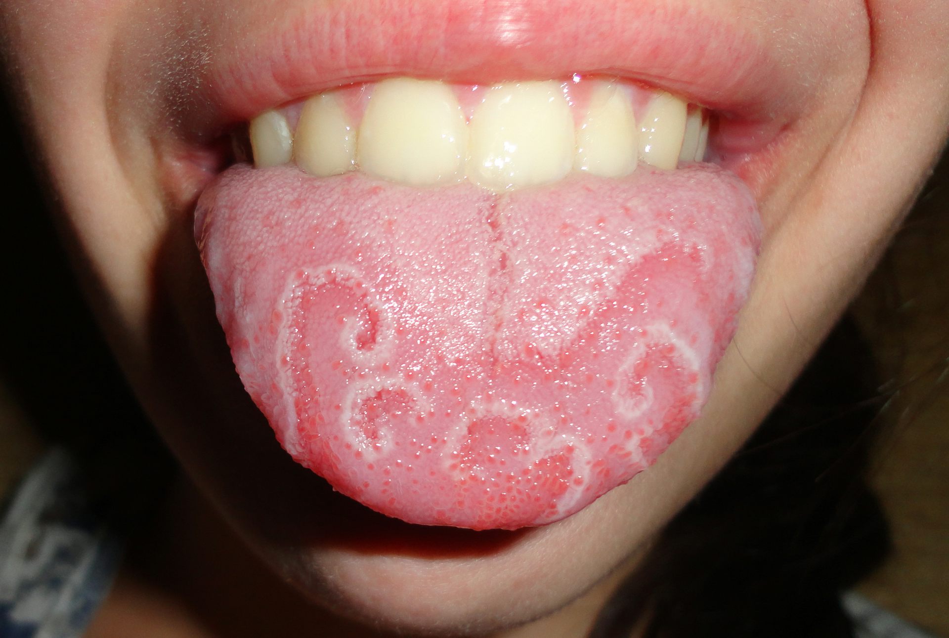 Geographic tongue: the mysterious condition that makes maps in your mouth