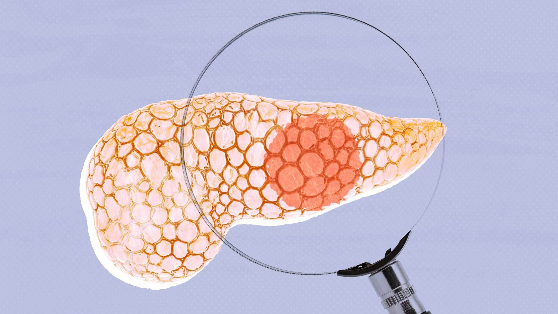 Pancreas cancer is difficult to treat. Why is that? 