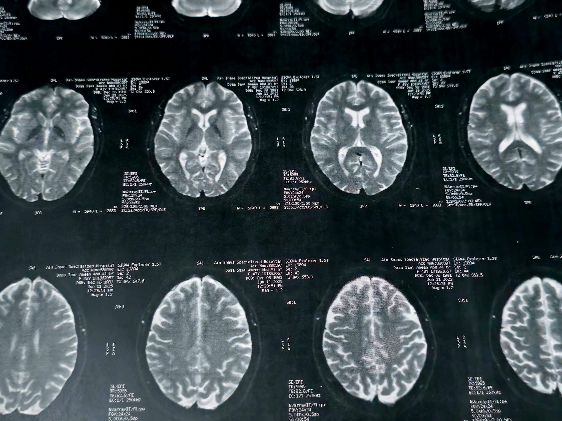 Several rows of black-and-white MRI scans showing horizontal cross-sections of a human brain, with different areas of brain tissue visible in shades of grey and white.