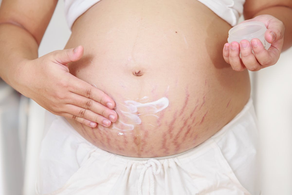 Health Check: why do I have stretch marks and I them?