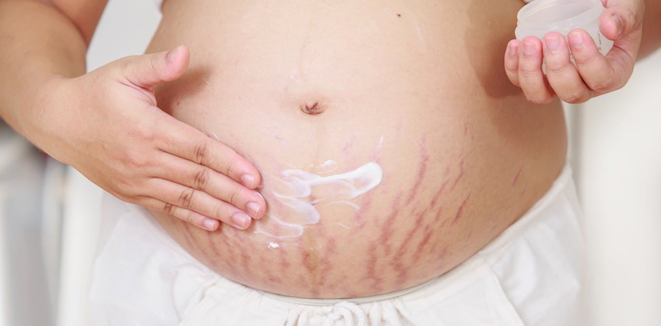 Health Check: why do I have stretch marks and what can I do about them?