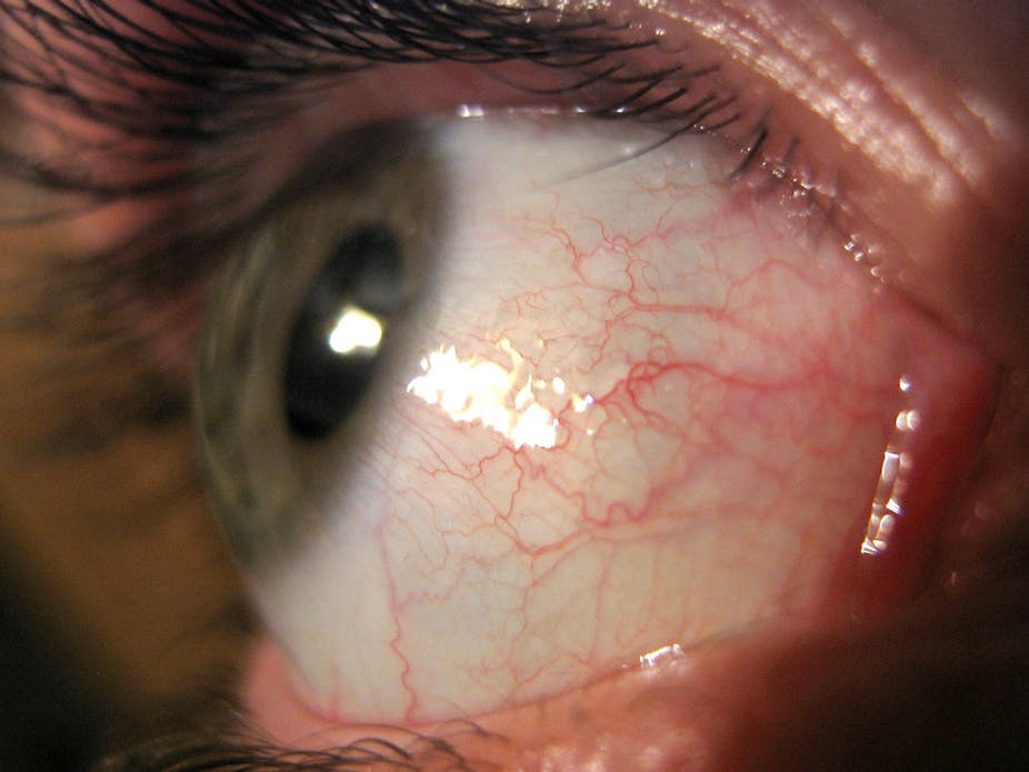 parasite worm in eye