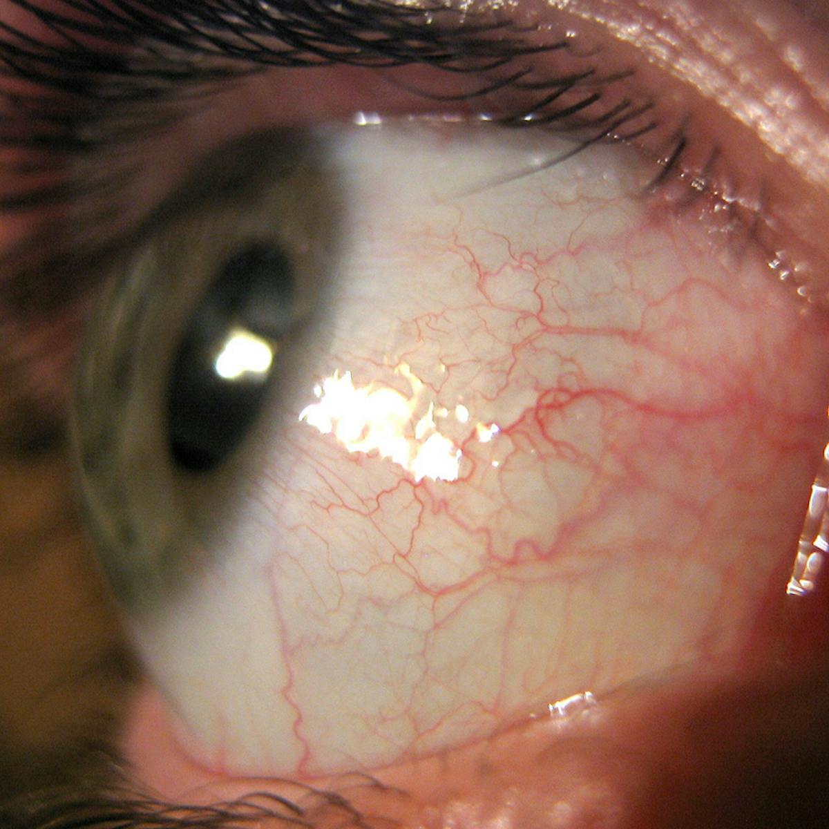 The Eye Opening Parasite That Can Get In Through Your Contact Lens