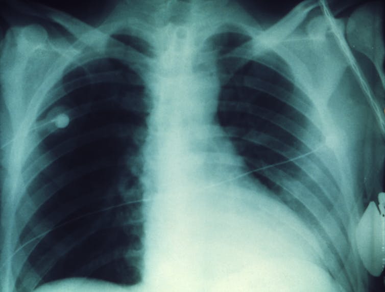 Mother died of TB along with newborn twins after eating infected dairy spreads D