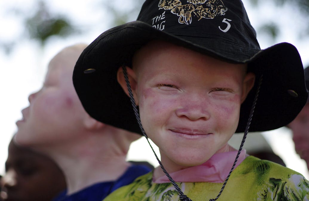 Africa needs a health policy to help people with albinism
