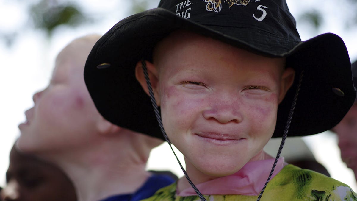 Africa needs a health policy to help people with albinism