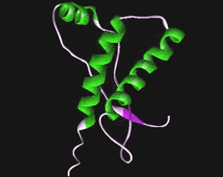 New prion disease raises questions about whether Alzheimer's and