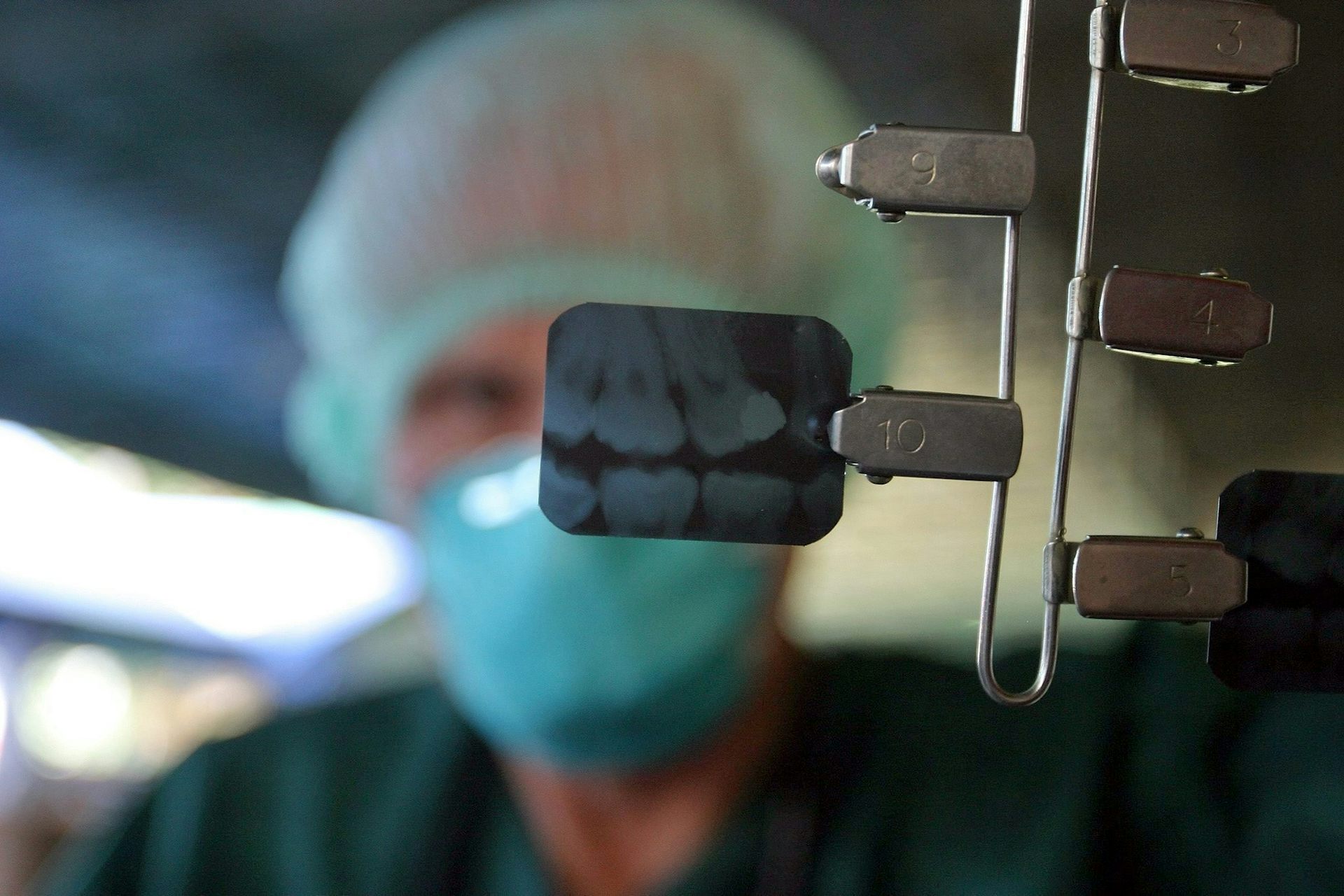 Dental Xrays linked to brain tumour risk