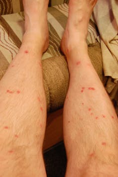 Taking The Ouch And Itch Out Of Insect Bites