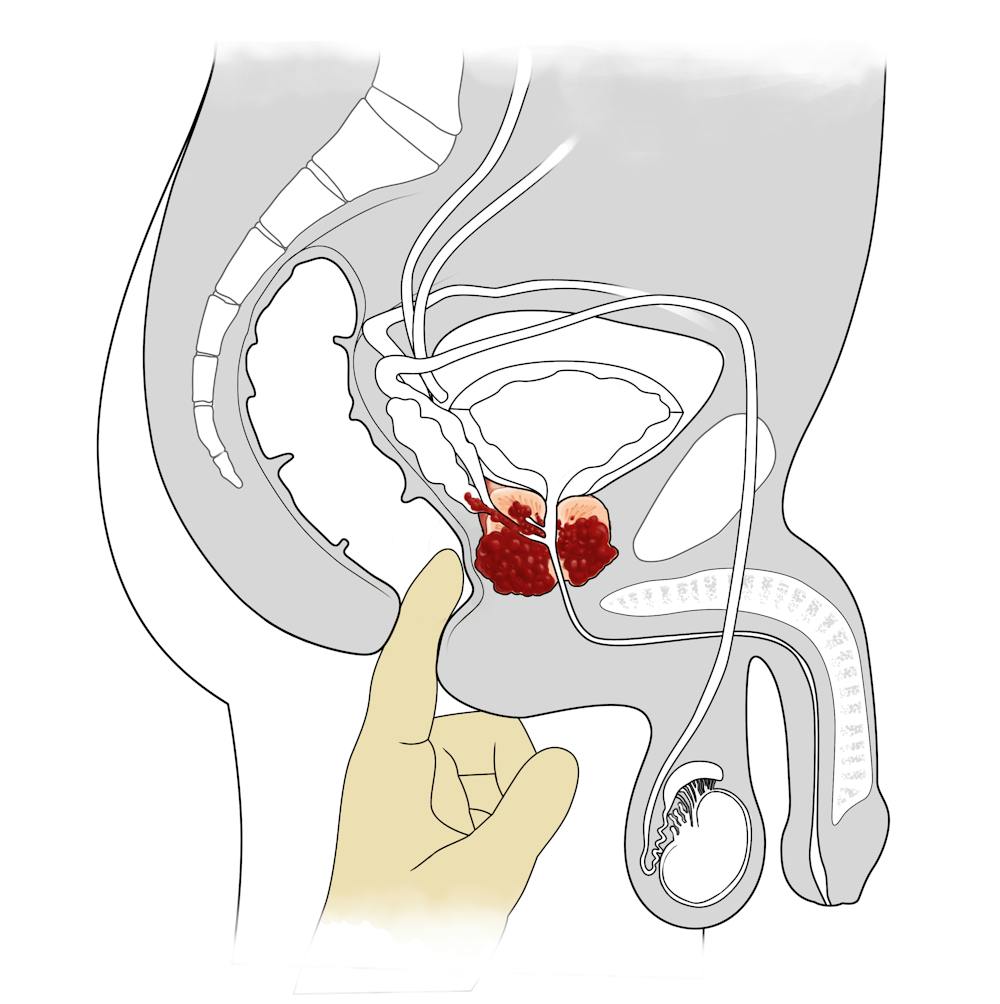 How To Check Your Prostate: 13 Steps (With Pictures) - Wikihow