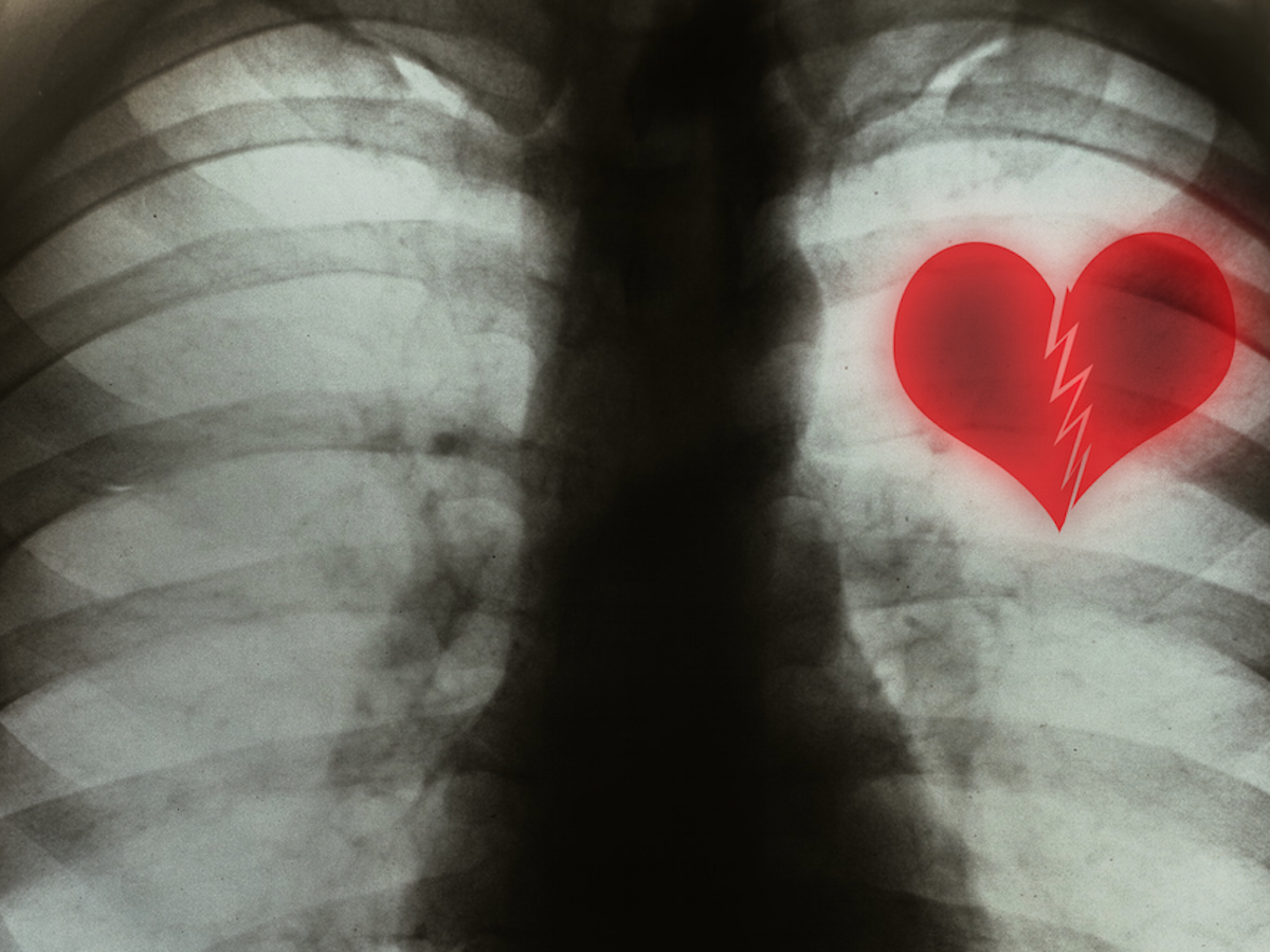 Which disease is also known as broken heart syndrome?