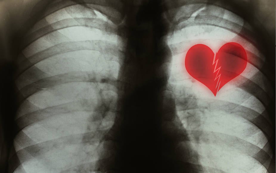 Fact Or Fiction Can We Die From A Broken Heart