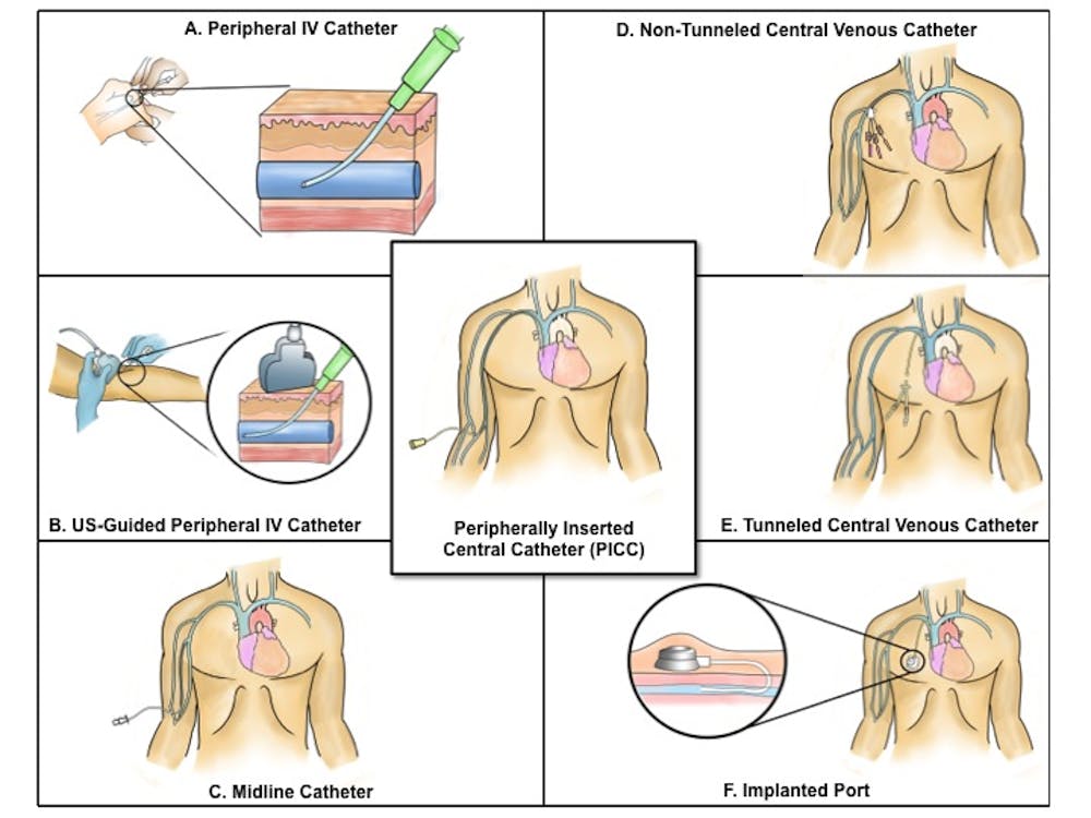 Differences Between Tunneled & Non-Tunneled Central Venous Catheters